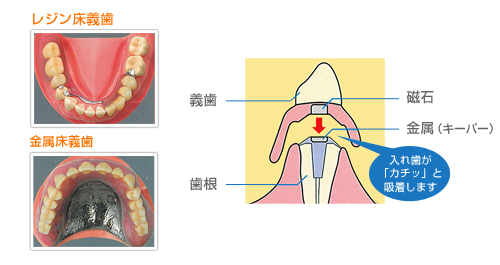 磁性アタッチメント義歯